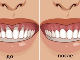 Вы заметили оголение шейки или корня зуба. Немедленно начинайте лечение — 6 натуральных рецептов