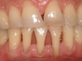 Вы заметили оголение шейки или корня зуба. Немедленно начинайте лечение — 6 натуральных рецептов