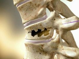 Как укрепить кости: народные способы и питание. Враги крепких костей