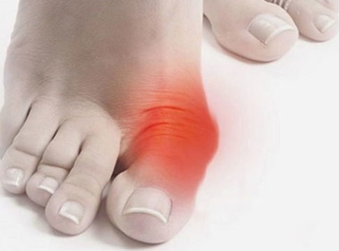 Народные методы от косточки на ноге. Препарат от шишек на ногах у большого пальца. Косточка на ноге у большого пальца. Рост кости на большом пальце ноги. Фиксатор "valgus pro" (вальгус про).