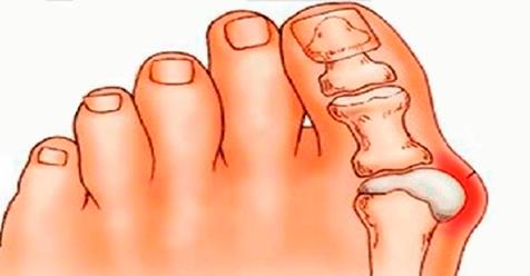 Картинки по запросу Косточки на ногах: эти 4 натуральных средства эффективно выведут соли и быстро избавят от боли