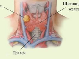 Как вылечuть узел на щитовидке